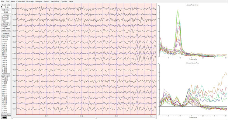 Dynamic z-score FFT eyes-closed baseline showing 9 Hz peak frequency